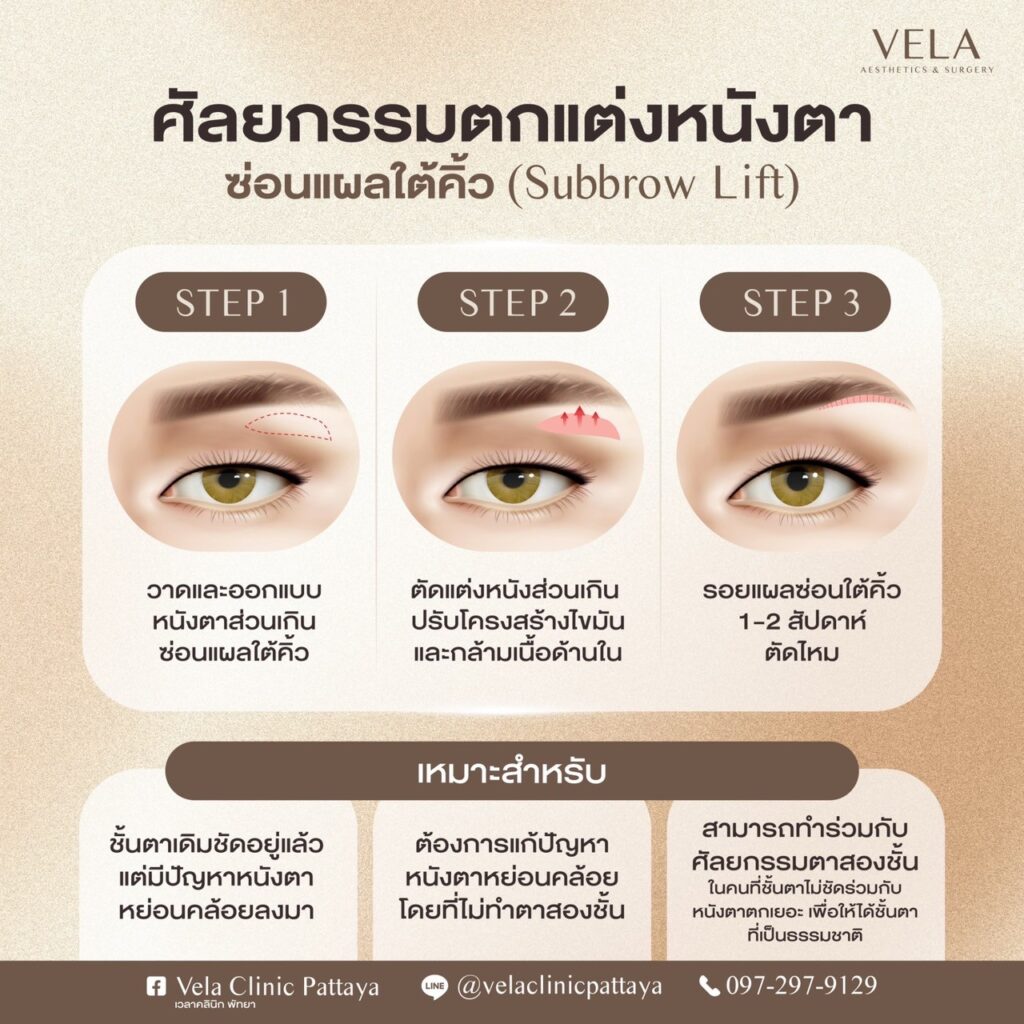 ซ่อนแผลใต้คิ้ว (Subbrow Lift)