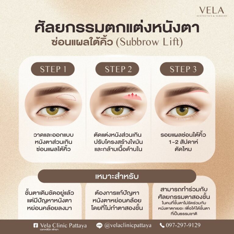 ซ่อนแผลใต้คิ้ว (Subbrow Lift)